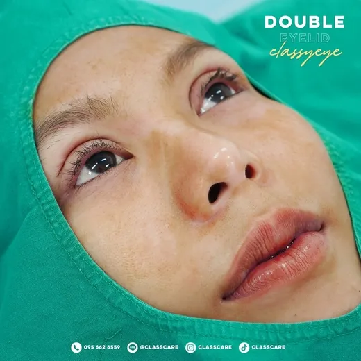 หลังทำตาสองชั้นกินอะไรได้บ้าง