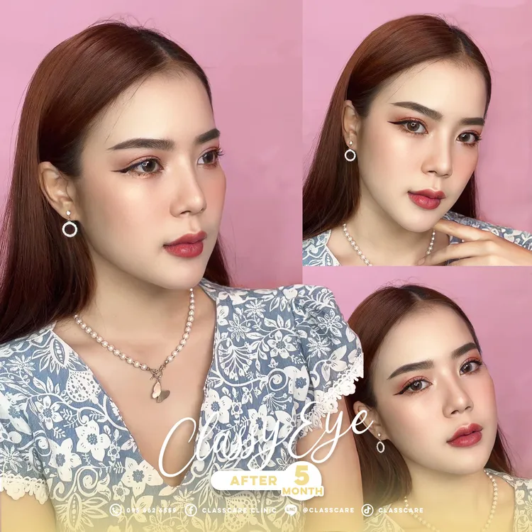 ผลลัพธ์ตาสองชั้น 5 เดือน ดูดีไม่มีโป๊ะ