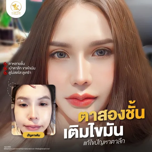 ดวงตาสดใสขึ้นด้วยการเติมไขมัน