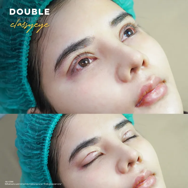 ขั้นตอนการทำตาสองชั้นแบบ Classy Eye