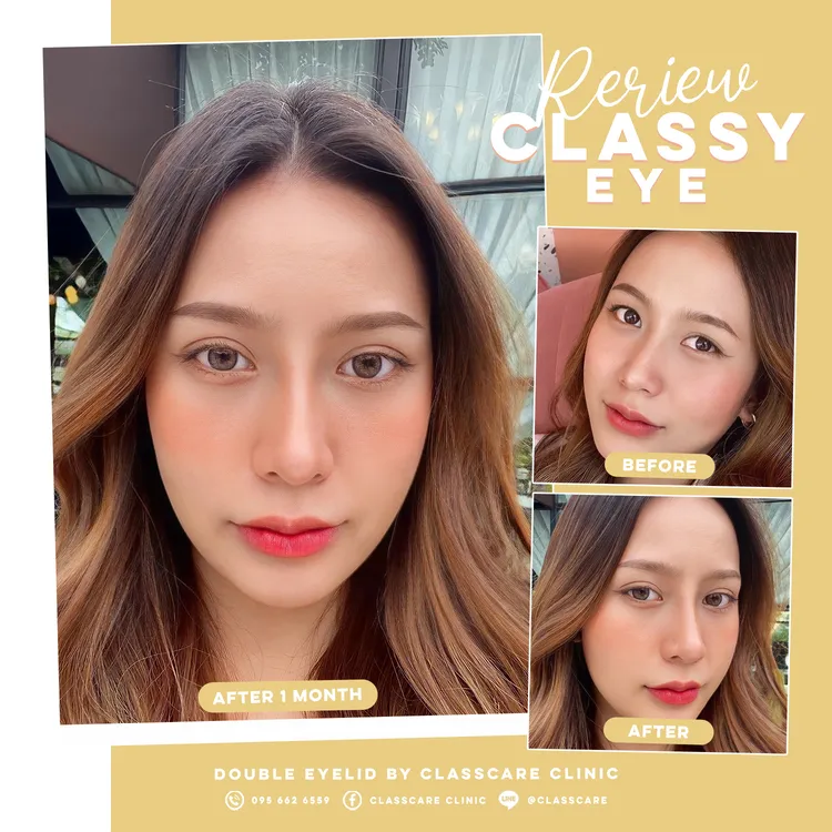 รีวิวการทำตาสองชั้นแบบ Classy Eye