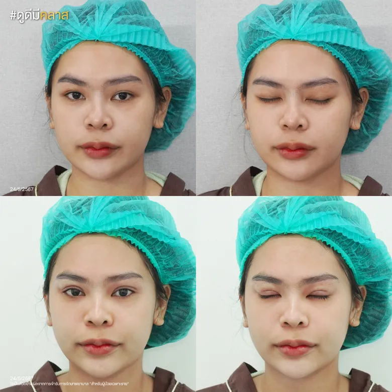 ศัลยกรรมตาสองชั้น Classy Eye ก่อนและหลัง