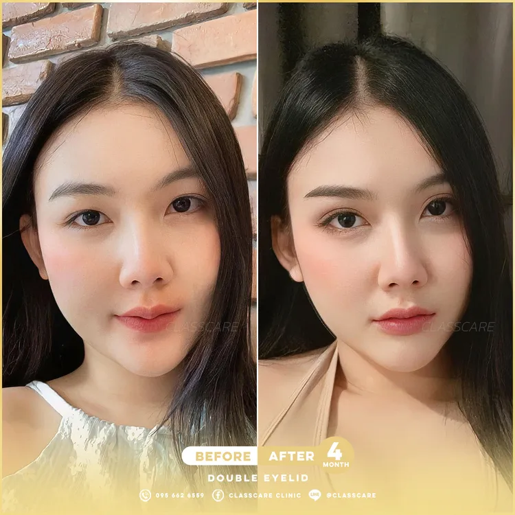 ตาสองชั้น ก่อนและหลัง 4 เดือน