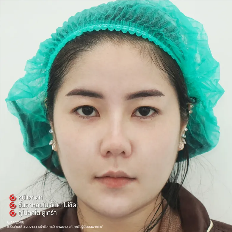 ปัญหาหนังตาตก