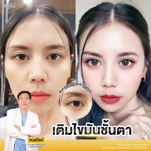 เติมไขมันใต้ตา: ก่อนและหลัง