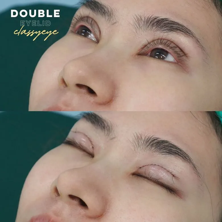 ตาสองชั้น Classy Eye ทันทีหลังทำ