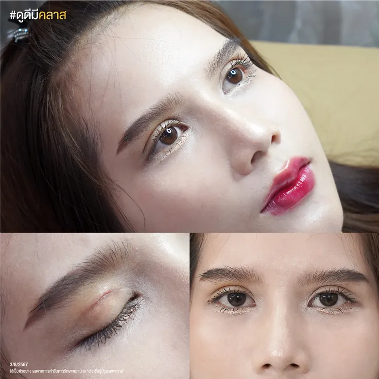 ผลลัพธ์ Classy Eye ระยะใกล้
