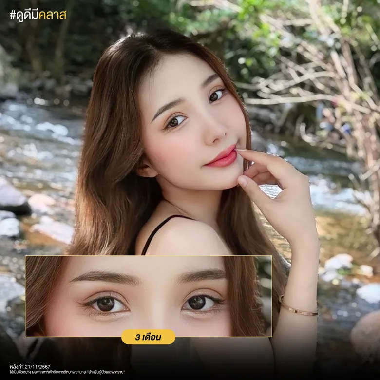 ผลลัพธ์ Classy Eye หลัง 3 เดือน
