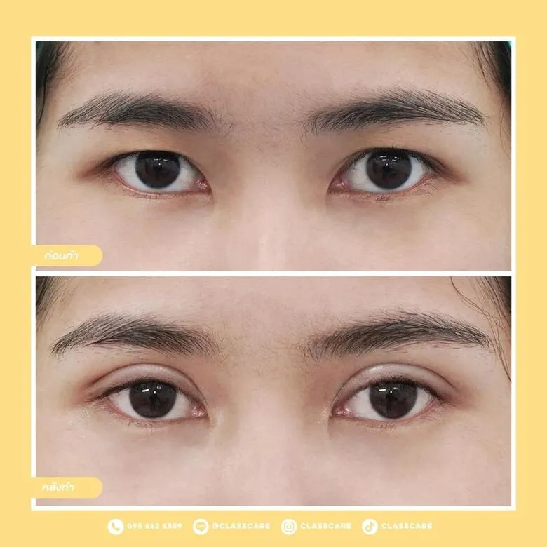 ตาสองชั้น ก่อน-หลัง (เฉพาะดวงตา)