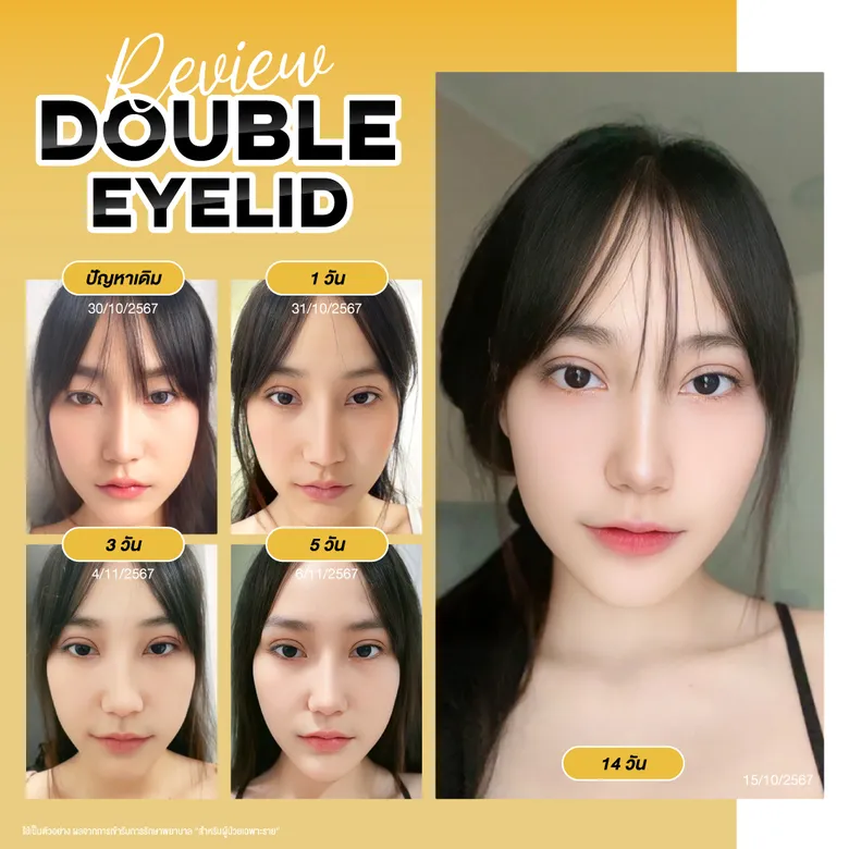 รีวิวตาสองชั้น ความคืบหน้าการฟื้นตัว