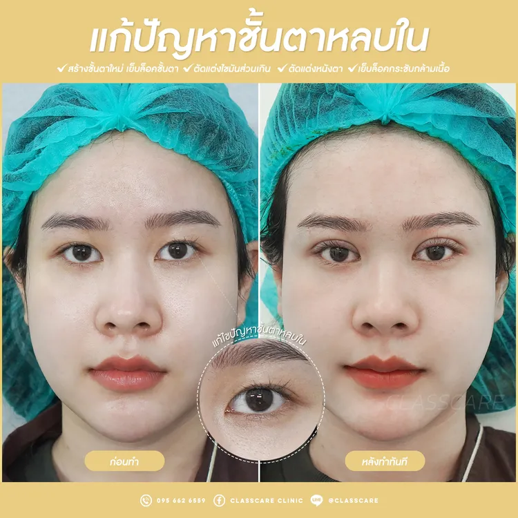 การแก้ไขตาสองชั้นหลบใน ก่อน-หลัง