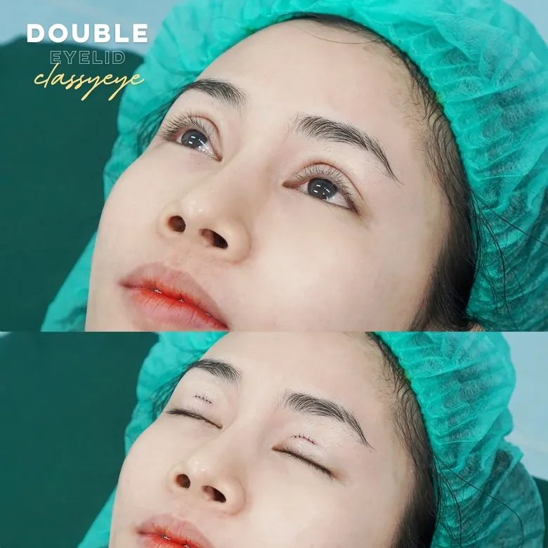 ศัลยกรรมตาสองชั้น: ก่อนและหลัง