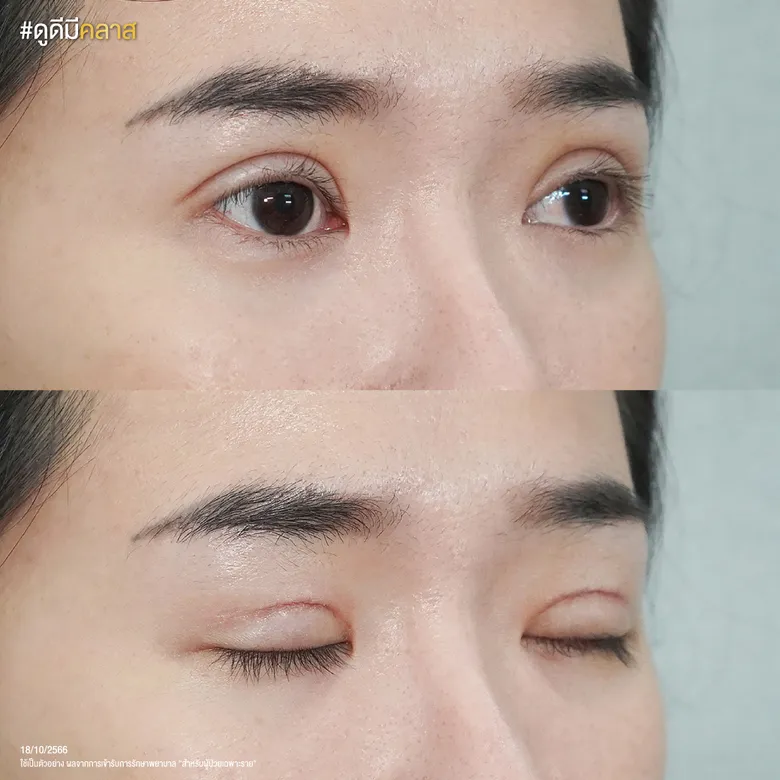 ก่อนและหลังทำศัลยกรรมตาสองชั้น