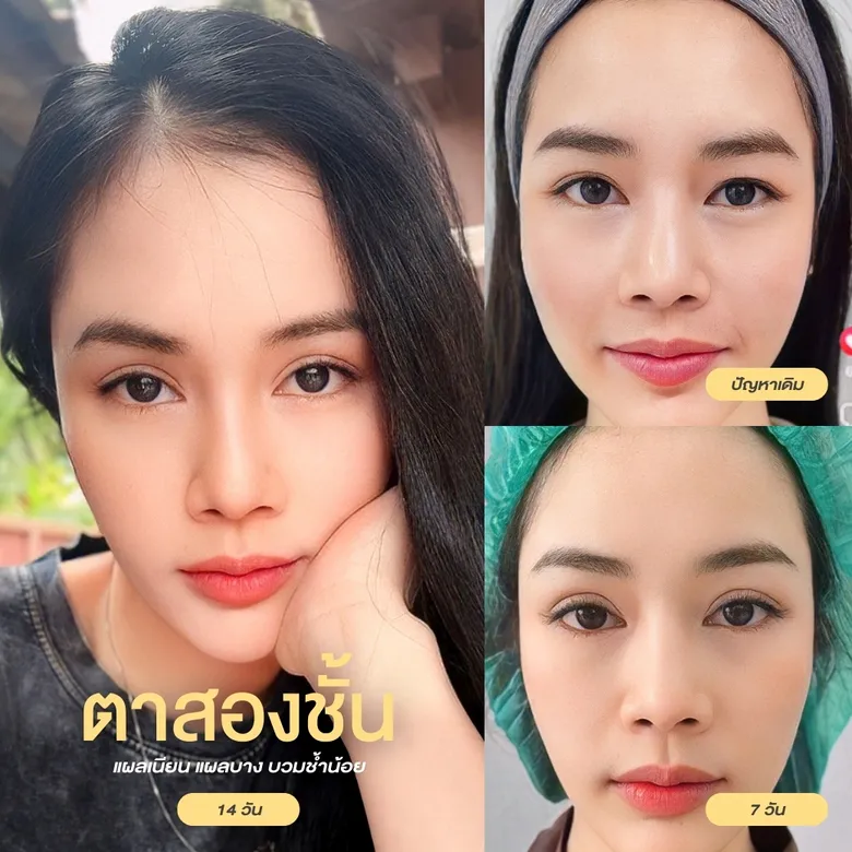 แผลเนียน แผลบาง บวมช้ำน้อย