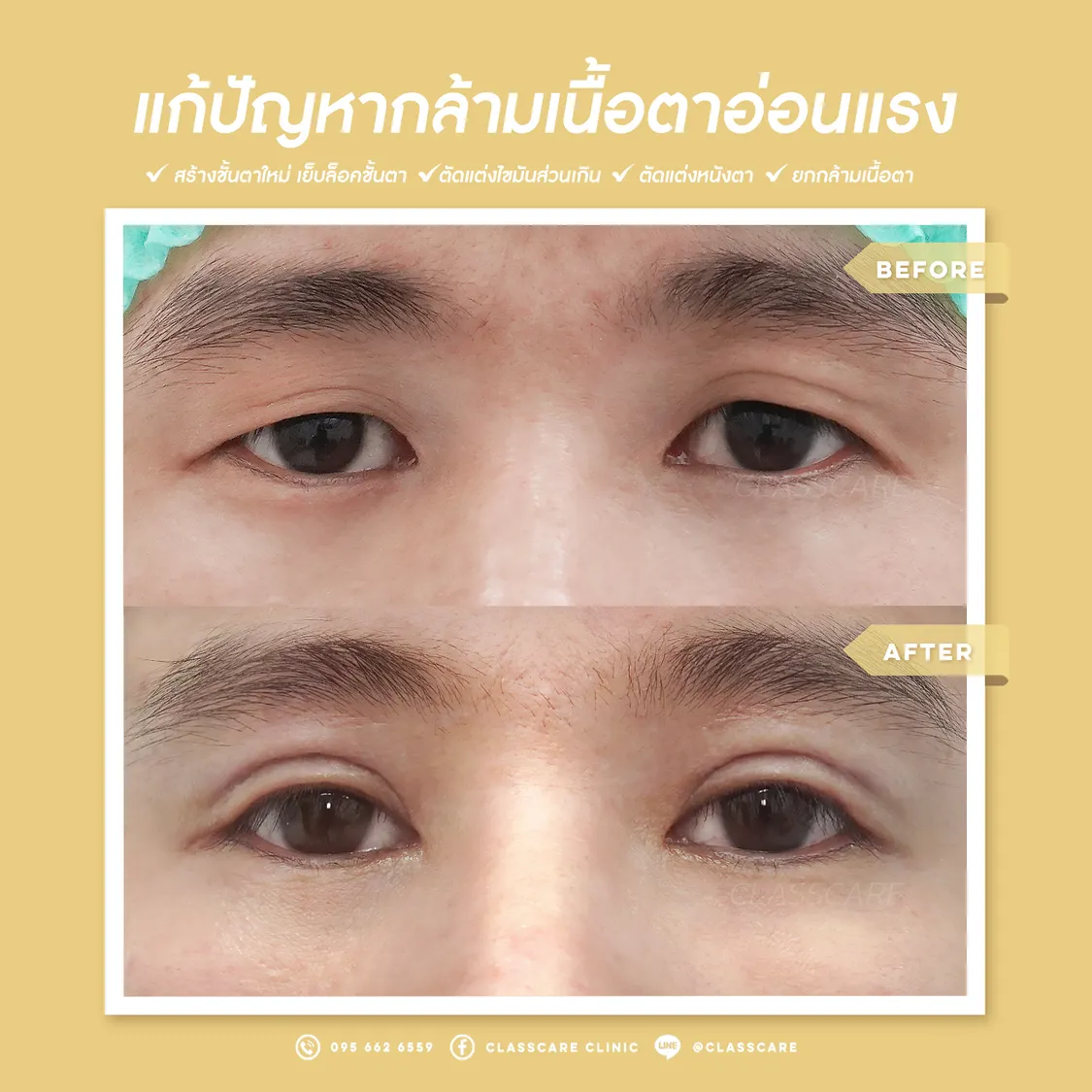 แก้ปัญหา กล้ามเนื้อตาอ่อนแรง