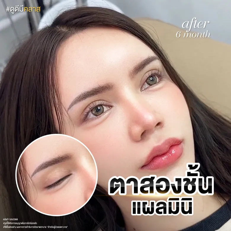 ตาสองชั้นแผลมินิ หลัง 6 เดือน