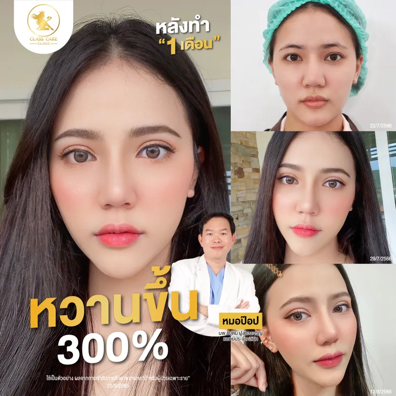 หลังทำ 1 เดือนหวานขึ้น 300%