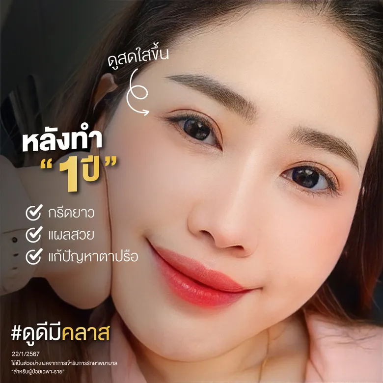 หลังทำ 1 ปีดูสดใสขึ้น