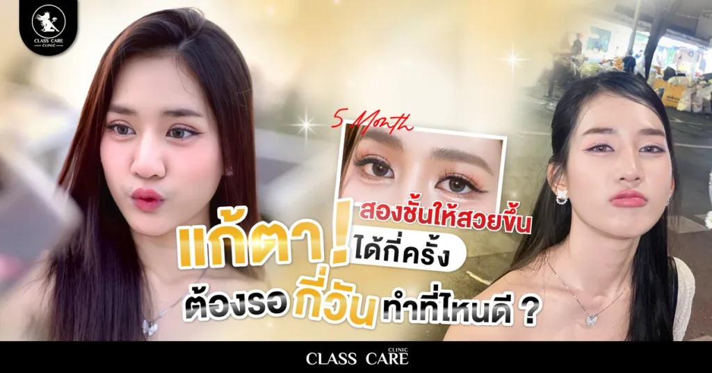 แก้ตาสองชั้นให้สวยขึ้น ทำได้ไหม แก้ตาได้ กี่ครั้ง ต้องรอกี่วัน ทำที่ไหนดี?