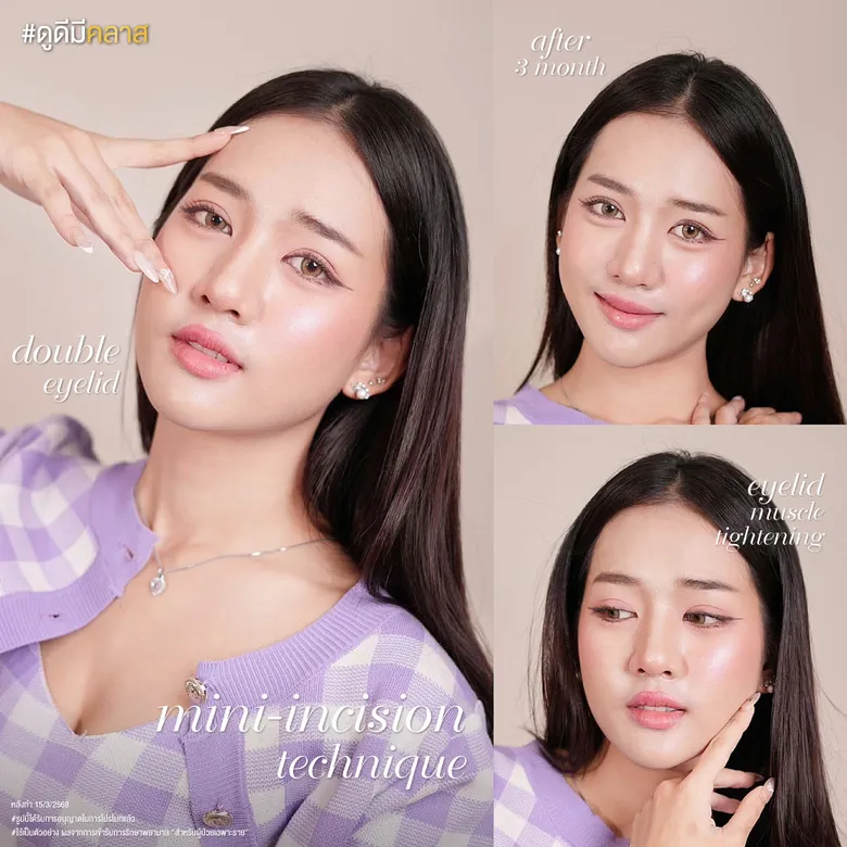 เทคนิคกรีดตาสองชั้นแบบแผลเล็ก
