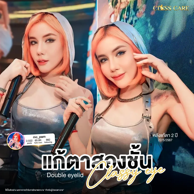 แก้ตาสองชั้นClassy Eye