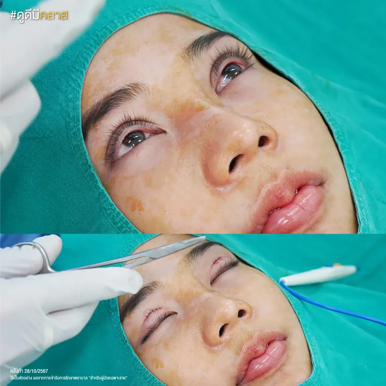 ศัลยกรรมตาสองชั้นขั้นตอนการผ่าตัด