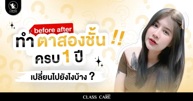 ทําตาสองชั้นครบ 1 ปีเปลี่ยนไปยังไงบ้าง?