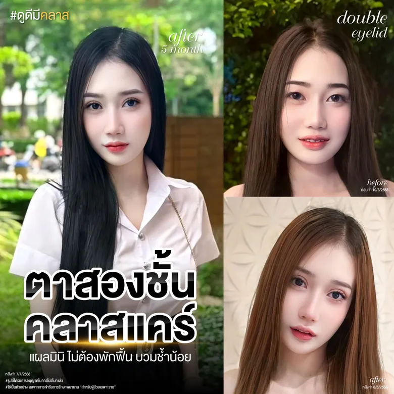 ตาสองชั้น คลาสแคร์แผลมินิ ไม่ต้องพักฟื้น บวมช้ำน้อย