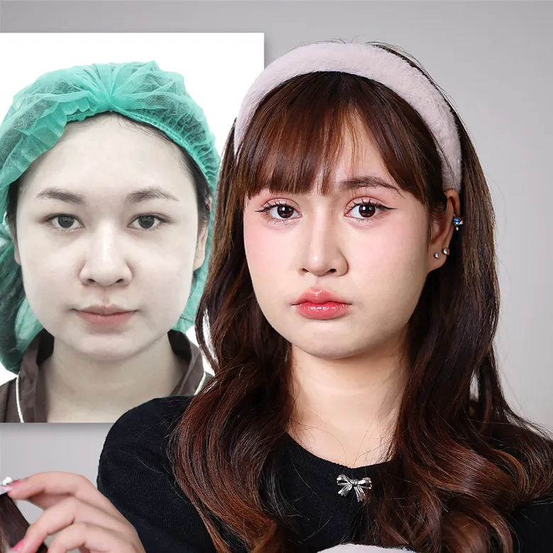 ก่อนและหลังทำศัลยกรรมตา