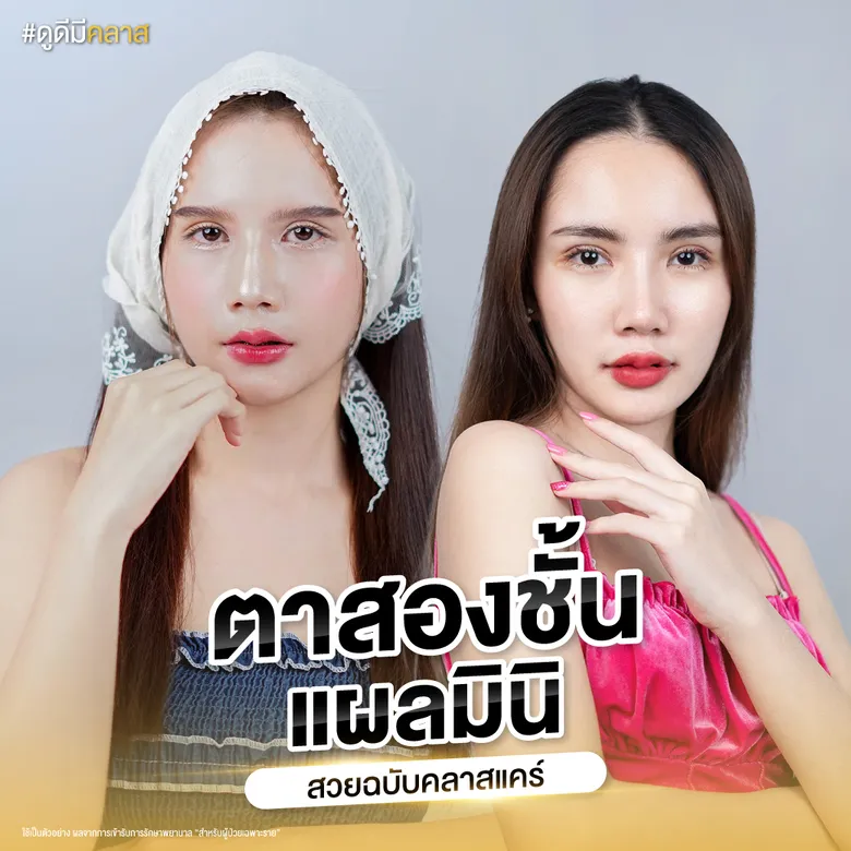 ตาสองชั้นแผลเล็กสไตล์คลาสแคร์