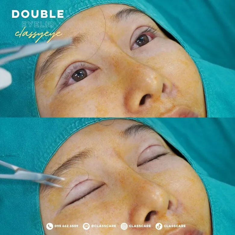 ภาพขณะผ่าตัดตาสองชั้น Classy Eye