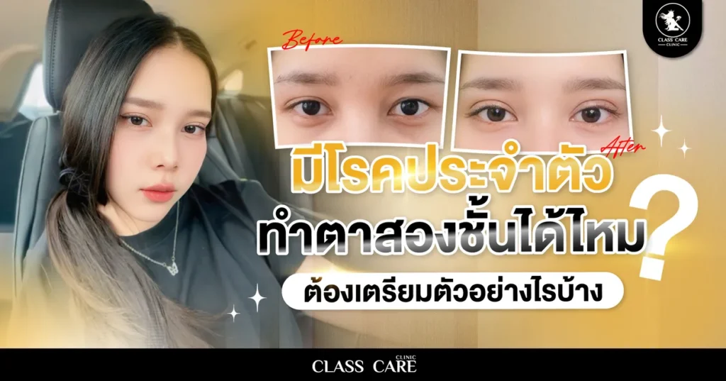 มีโรคประจำตัว ทำตาสองชั้นได้ไหม? ต้องเตรียมตัวอย่างไรบ้าง