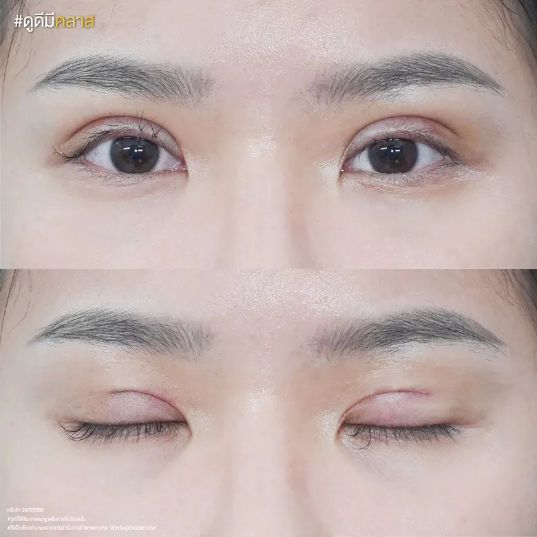 ศัลยกรรมเปลือกตา ก่อน-หลัง (มุมใกล้)