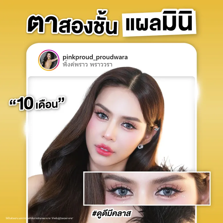 อัปเดตตาสองชั้นแผลเล็ก 10 เดือน
