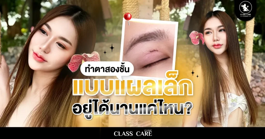 ทำตาสองชั้นแผลเล็ก อยู่ได้นานแค่ไหน?