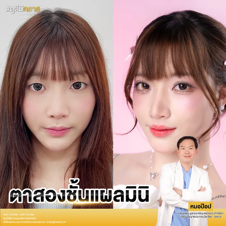 ตาสองชั้นแผลเล็กโดยหมอป๊อป ก่อน-หลัง
