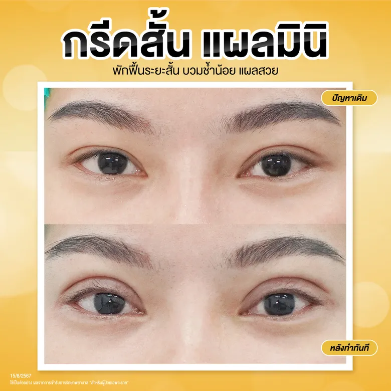 ตาสองชั้นแผลเล็ก ก่อน-หลังทำทันที