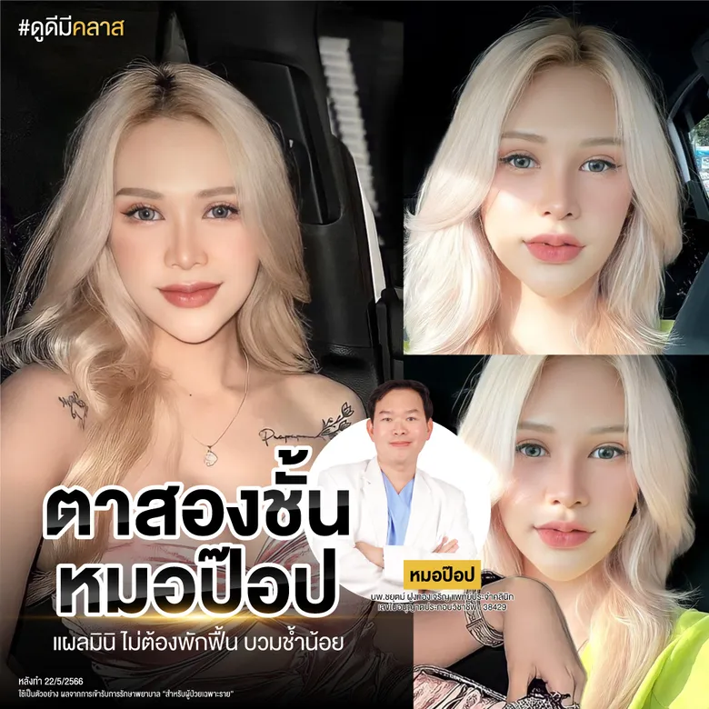 รีวิวการทำตาสองชั้นด้วยเทคนิคแผลเล็ก-01
