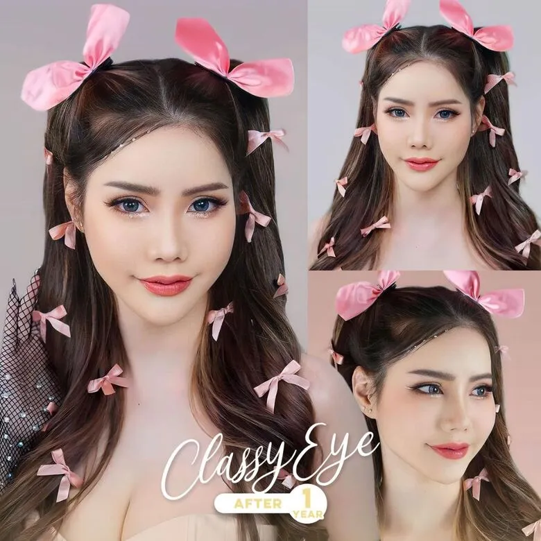 รีวิวการทำตาสองชั้นด้วยเทคนิคแผลเล็ก-09