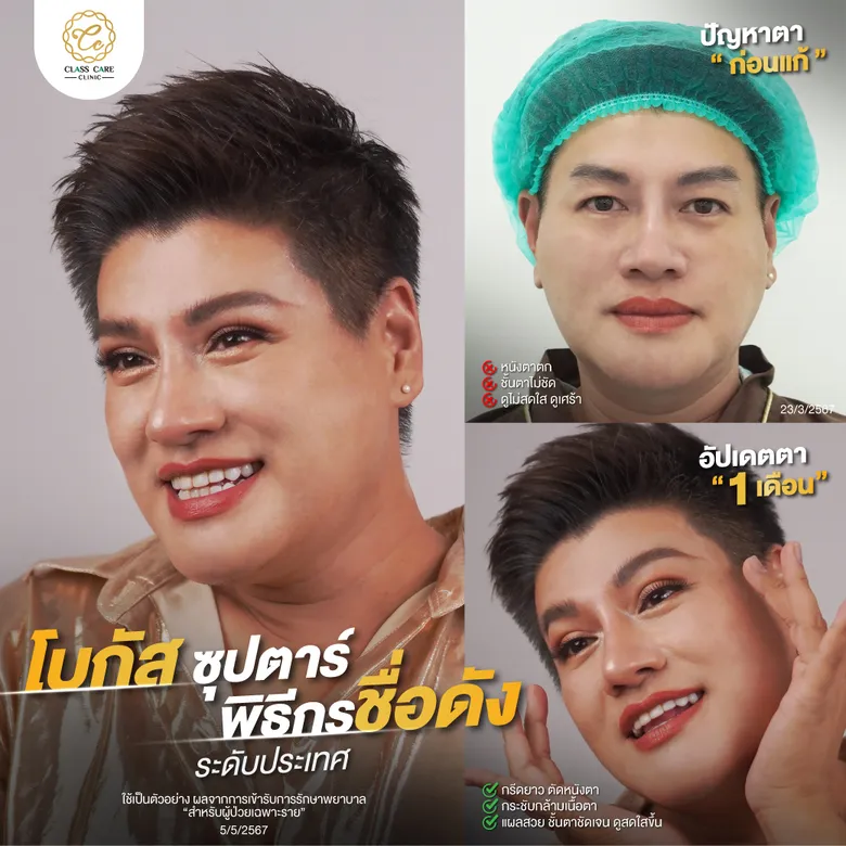 อัปเดตศัลยกรรมตาเซเลบ 1 เดือน