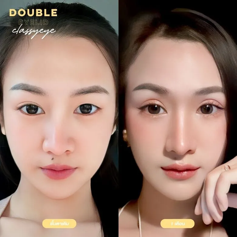 ตาสองชั้น Classy Eye หลัง 1 เดือน