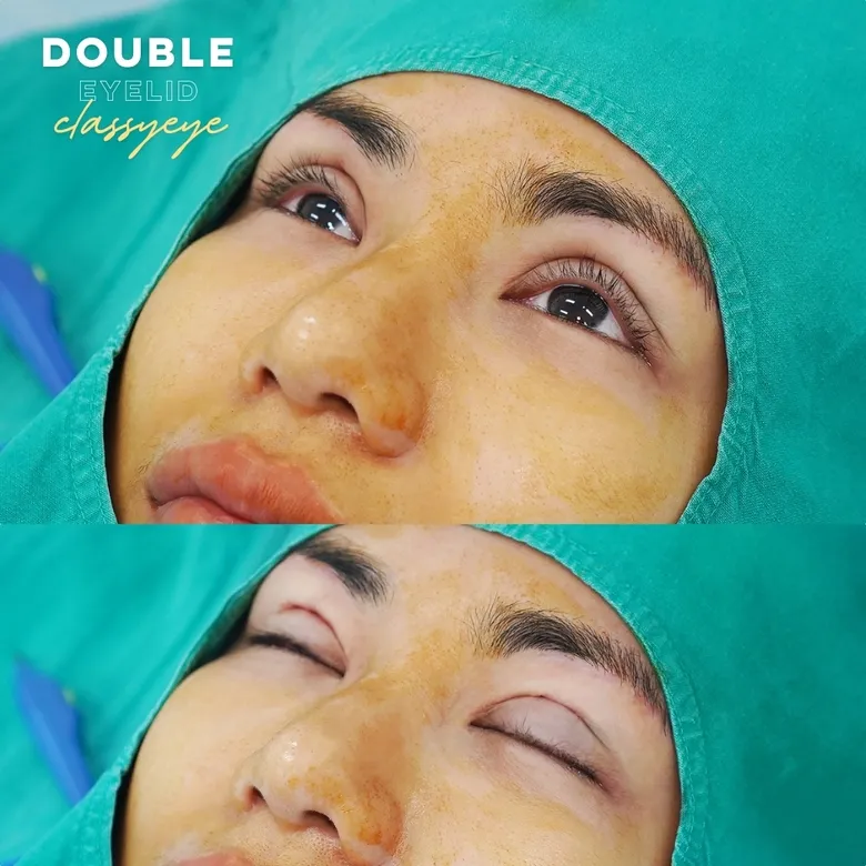 ขั้นตอนการทำตาสองชั้น Classy Eye