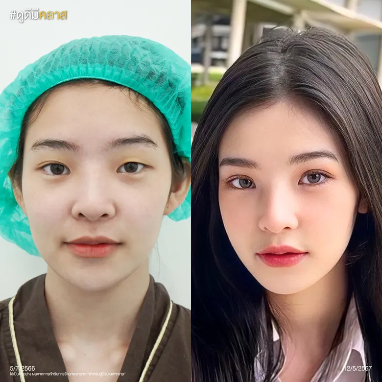 ศัลยกรรม Classy Eye ก่อน-หลัง