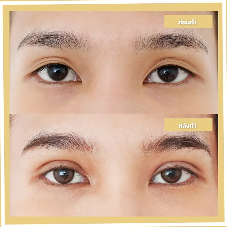 ตาสองชั้น ก่อน-หลัง (เฉพาะดวงตา)
