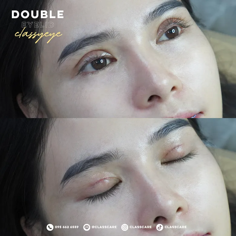 ตาสองชั้น Classy Eye ก่อน-หลัง (มุมใกล้)