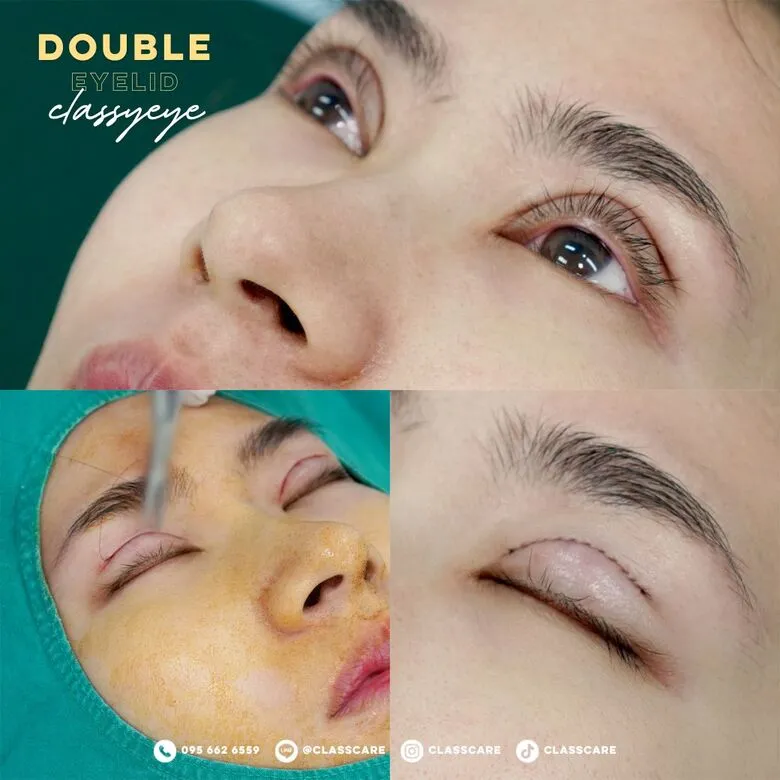 ภาพระยะใกล้ขณะทำตาสองชั้น Classy Eye