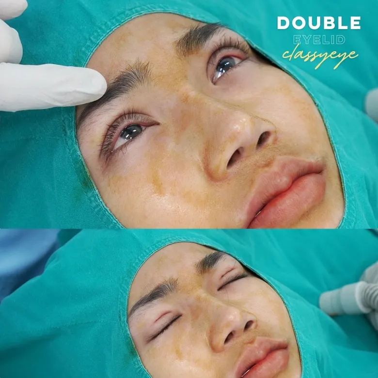 ภาพขณะทำตาสองชั้น Classy Eye