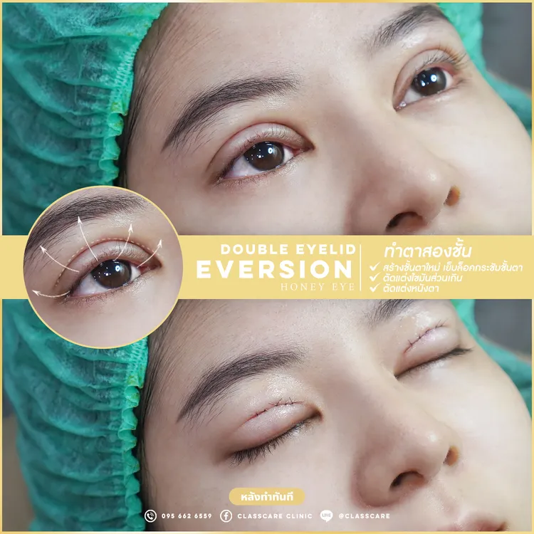 ตาสองชั้น Eversion Honey Eye หลังทำทันที