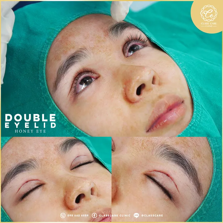 ขั้นตอนการทำตาสองชั้น Honey Eye