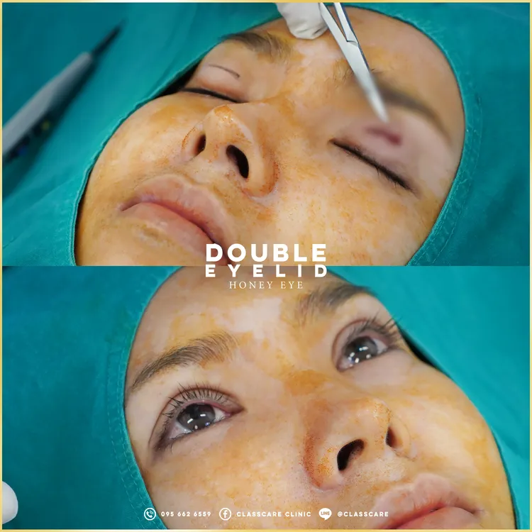 ภาพระยะใกล้ขณะทำตาสองชั้น Honey Eye